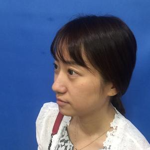 蚌埠韓美美萊整形做玻尿酸面部除皺效果怎么樣？附陳澤醫(yī)生案例效果圖