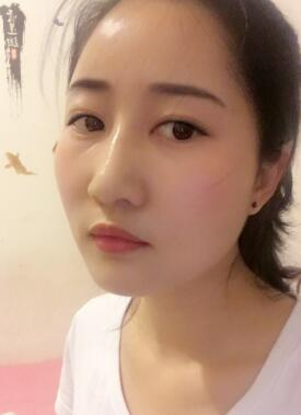 鞍山菲之都整形醫(yī)生李宗亮做字體脂肪豐太陽穴效果怎么樣？附案例效果對比圖