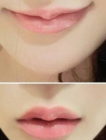 巴中時光醫(yī)學(xué)美容門診部做玻尿酸豐唇效果怎么樣？附李紅強(qiáng)豐唇案例