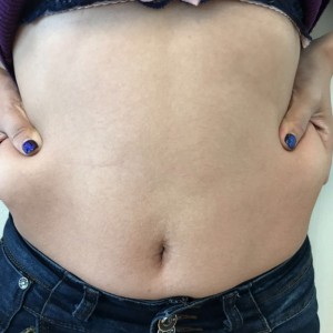 蚌埠韓美美萊整形醫(yī)生張濤做水動力吸脂怎么樣？附吸脂案例效果圖