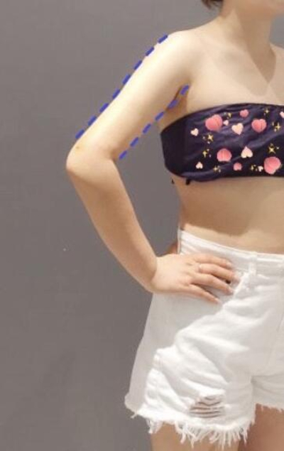 蚌埠市第三人民醫(yī)院燒傷整形科楊蔚做手臂吸脂效果對比圖