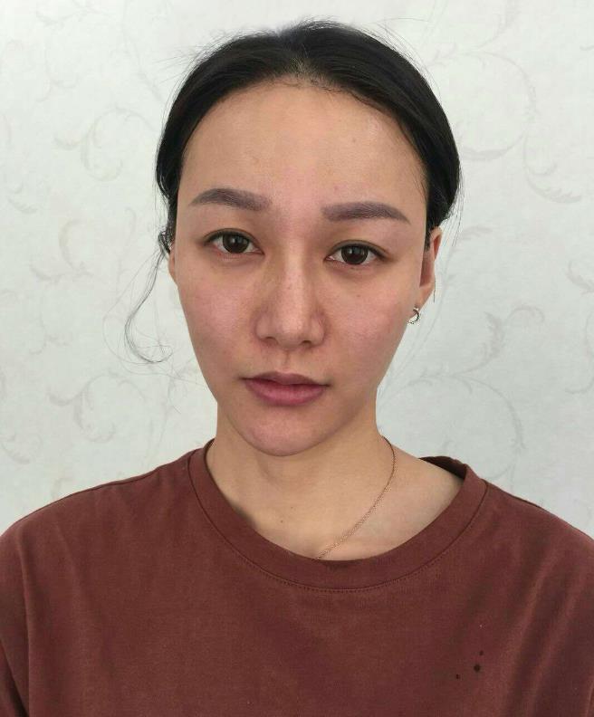 鞍山王景醫(yī)療美容外科診所做光子嫩膚怎么樣？附王景醫(yī)生案例效果圖