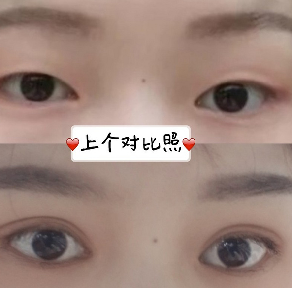 鞍山菲之都醫(yī)療整形醫(yī)院做開眼角+全切雙眼皮效果怎么樣？附藺嬌婷醫(yī)生案例