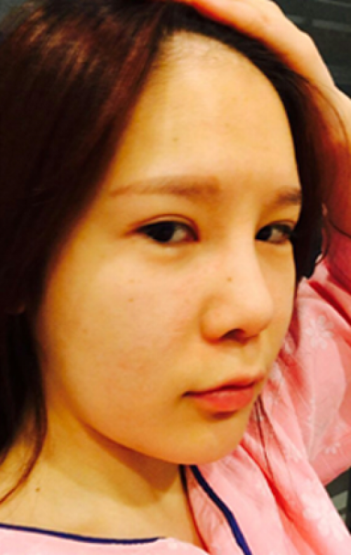 安康希顏醫(yī)療整形醫(yī)生王奇效做面部吸脂怎么樣？附案例效果對(duì)比圖