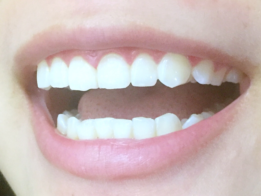 安慶渡江口腔醫(yī)院張良斌醫(yī)生做超聲波洗牙效果怎么樣？附洗牙案例效果圖