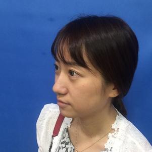 蚌埠韓美美萊整形做玻尿酸面部除皺效果怎么樣？附陳澤醫(yī)生案例效果圖