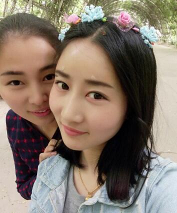 鞍山菲之都整形醫(yī)生李宗亮做字體脂肪豐太陽(yáng)穴效果怎么樣？附案例效果對(duì)比圖