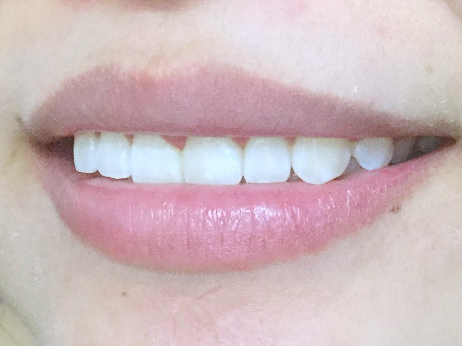 安慶渡江口腔醫(yī)院張良斌醫(yī)生做超聲波洗牙效果怎么樣？附洗牙案例效果圖