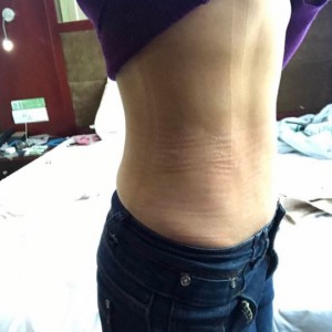 蚌埠韓美美萊整形醫(yī)生張濤做水動力吸脂怎么樣？附吸脂案例效果圖