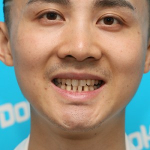 鞍山時(shí)代口腔門診部做瓷貼面案例效果圖 鞍山時(shí)代口腔門診部做瓷貼面案例效果圖