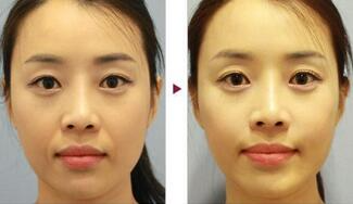 保定安卓貝拉做注射去法令紋怎么樣？附儲君醫(yī)生法令紋案例效果圖