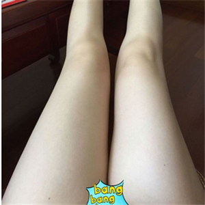 保定市第五醫(yī)院美容整形科做大腿吸脂怎么樣？附劉根立醫(yī)生案例效果圖