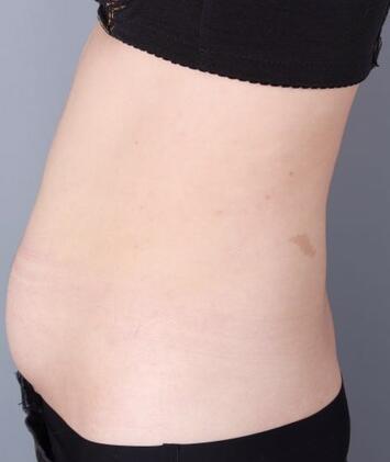 保定現(xiàn)代女子醫(yī)院整形美容中心做腰腹部吸脂怎么樣？附林秀蓮醫(yī)生案例效果圖