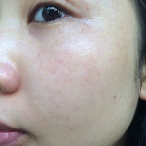 寶雞皮膚病醫(yī)院文東亮醫(yī)生做臉部祛斑效果怎么樣？附臉部祛斑案例