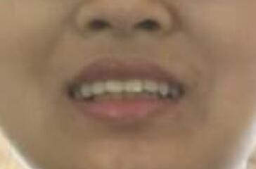 保定東陽(yáng)口腔醫(yī)院馮春城醫(yī)生做烤瓷牙怎么樣?附烤瓷牙案例效果對(duì)比圖