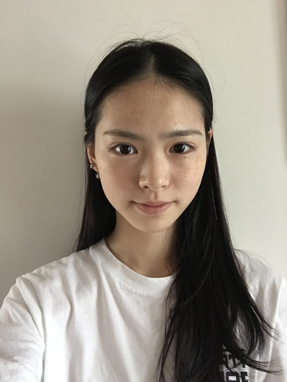 保定市第五醫(yī)院美容整形科做激光祛斑怎么樣？附單敬依醫(yī)生案例效果圖