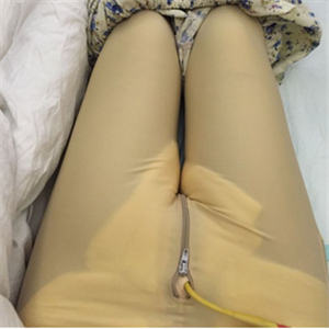 保定市第五醫(yī)院美容整形科做大腿吸脂怎么樣？附劉根立醫(yī)生案例效果圖