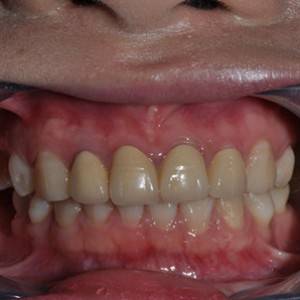 保定東陽口腔醫(yī)院張亞靜醫(yī)生做牙齒冷光美白怎么樣？附冷光美白案例效果對比圖