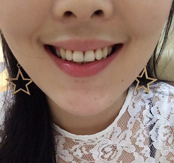 保定東陽口腔醫(yī)院白小青醫(yī)生做牙齒矯正怎么樣?附牙齒矯正案例效果對比圖 保定東陽口腔醫(yī)院白小青醫(yī)生做牙齒矯正怎么樣?附牙齒矯正案例效果對比圖