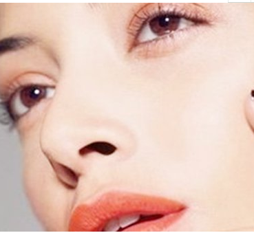 珠海陸達美容外科醫(yī)院假體隆鼻