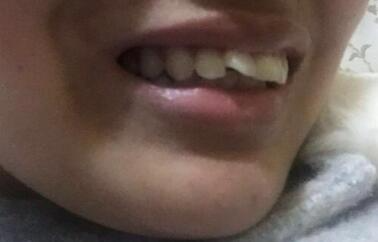 保定東陽口腔醫(yī)院馮春城醫(yī)生做烤瓷牙怎么樣？附烤瓷牙案例效果對比圖