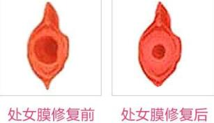 蚌埠市第三人民醫(yī)院燒傷整形科許瑾醫(yī)生做處女摸修復(fù)怎么樣？附案例