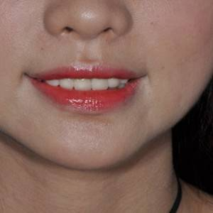 保定東陽口腔醫(yī)院張亞靜醫(yī)生做牙齒冷光美白怎么樣？附冷光美白案例效果對比圖