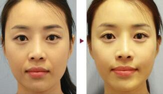 保定安卓貝拉做注射去法令紋怎么樣？附儲君醫(yī)生法令紋案例效果圖