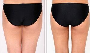 蚌埠市第三人民醫(yī)院燒傷整形科徐衛(wèi)東醫(yī)生做臀部吸脂效果怎么樣？