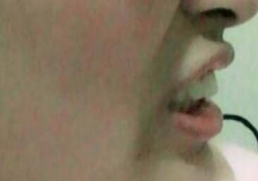 保定東陽(yáng)口腔醫(yī)院馮春城醫(yī)生做烤瓷牙怎么樣?附烤瓷牙案例效果對(duì)比圖