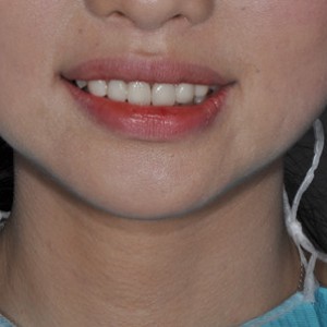 保定東陽口腔醫(yī)院張亞靜醫(yī)生做牙齒冷光美白怎么樣？附冷光美白案例效果對比圖