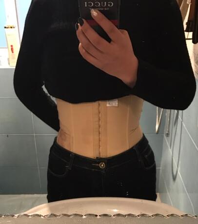 保定現(xiàn)代女子醫(yī)院整形美容中心做腰腹部吸脂怎么樣？附林秀蓮醫(yī)生案例效果圖