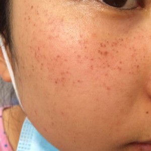 寶雞皮膚病醫(yī)院文東亮醫(yī)生做臉部祛斑效果怎么樣？附臉部祛斑案例