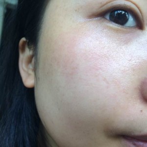 寶雞皮膚病醫(yī)院文東亮醫(yī)生做臉部祛斑效果怎么樣？附臉部祛斑案例