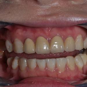 保定東陽口腔醫(yī)院張亞靜醫(yī)生做牙齒冷光美白怎么樣？附冷光美白案例效果對比圖