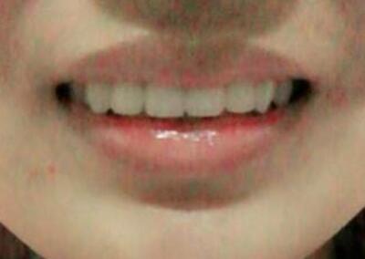 保定東陽(yáng)口腔醫(yī)院馮春城醫(yī)生做烤瓷牙怎么樣?附烤瓷牙案例效果對(duì)比圖