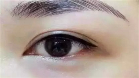 雙眼皮埋線手術(shù)價(jià)格是多少？雙眼皮埋線能保持多長時(shí)間？
