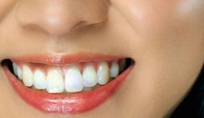 牙齒矯正大概需要花費多少錢？