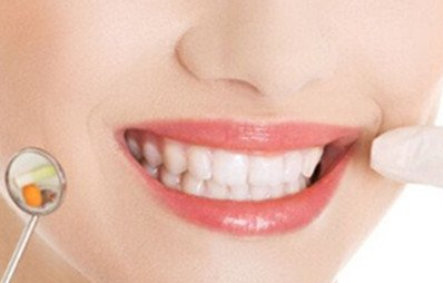 激光美白齒的效果一般怎么樣？