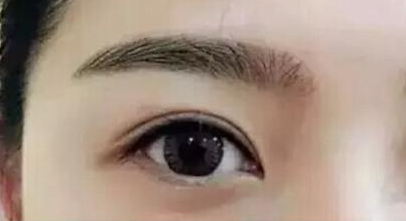 眼角修復(fù)多久能恢復(fù)？