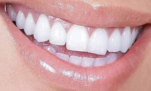 皓齒美白后的注意事項