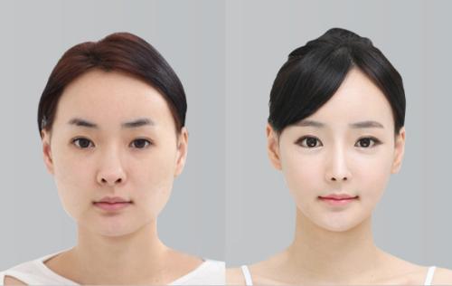 想做歐式雙眼皮，什么是歐式雙眼皮？