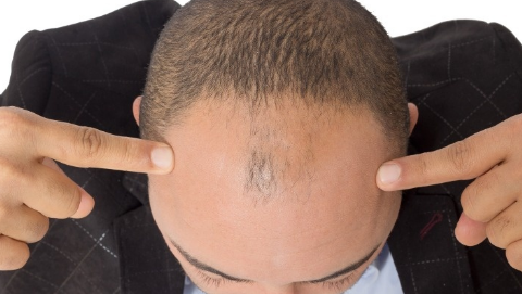 頭發(fā)可以種植嗎？頭發(fā)種植一般需要多少錢？