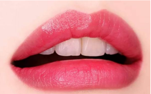 玻尿酸豐唇一般需要幾支呢？