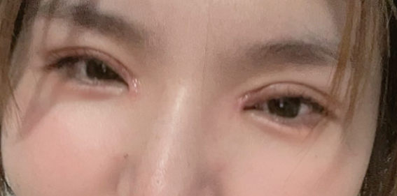 全切雙眼皮好看嗎？做全切雙眼皮手術(shù)需要多長時間？