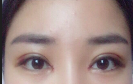 全切雙眼皮多少錢一次？全切雙眼皮后遺癥有哪些？