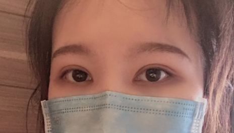 全切雙眼皮會(huì)越來(lái)越窄嗎？