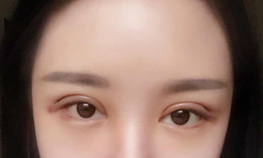 全切雙眼皮手術(shù)多少錢(qián)一次？