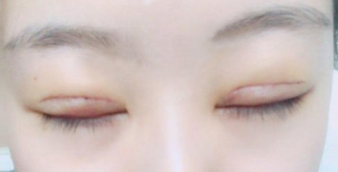 全切雙眼皮術(shù)后會留疤嗎？