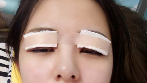 全切雙眼皮怎么恢復(fù)快？